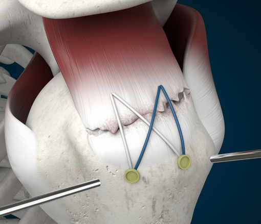 Suture Anchors Pose Surgical Challenge - Inovedis