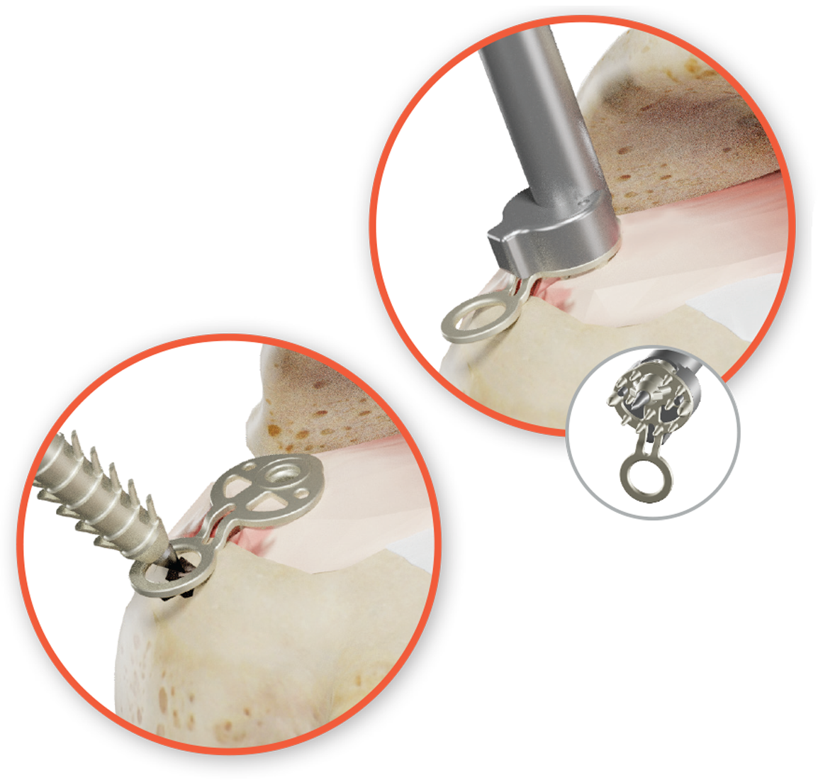 Sinefix Shoulder Surgery System